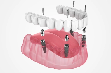 3D Render Showing All-On-4 Dental Implants
