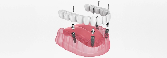 3D Render Showing All-On-4 Dental Implants