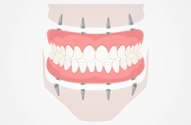Render Showing All-On-X Dental Implants