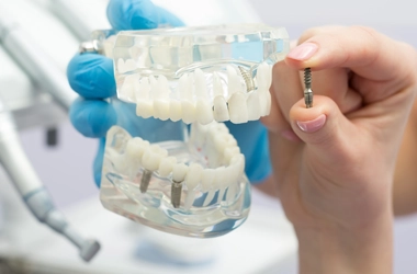 Clear Teeth Model Showing Dental Implant Anchors