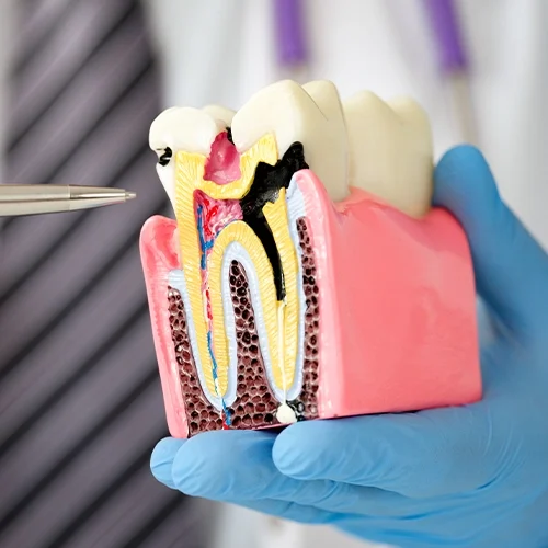 Large Cutaway Model Of A Tooth With A Cavity