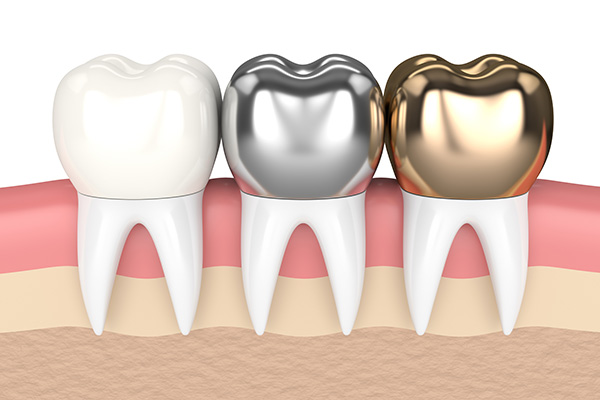 Metal Crowns Vs Porcelain Dental Crowns